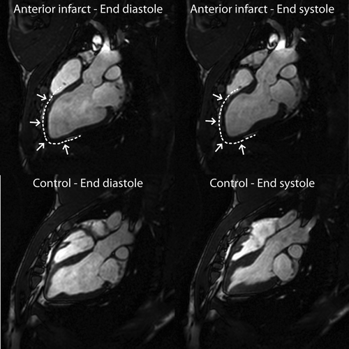 Figure 2.  CMR images of LV long-axis in end-diastole (left column) and end-systole (right column) of an intervention animal (top row) versus a control animal (bottom row). The infarction is marked by a dashed line and arrows and is clearly seen to involve the septum, the apex, and the free wall of the LV.