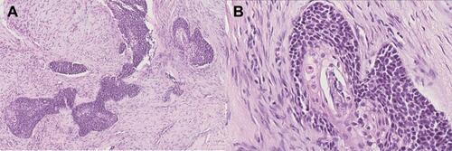 Figure 2 Histomorphological details of NC. Tumor was composed of basaloid squamous cells. The periphery of the tumor nests was arranged in a palisade pattern. Focal abrupt keratinization could be seen (A ×100; B ×400).