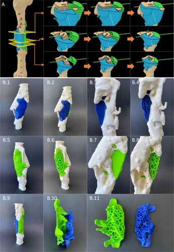 Figure 8. Patient-specific fit and unobstructive insertion of the output scaffold designs were validated by first digitally inserting the solid scaffold geometries into the defect cavity within R&G (A), and subsequently, by 3D printing prototypes in PLA and physically inserting them (B).