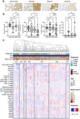 Figure 3. The immune cell infiltration, HLA-I expression and immune checkpoint (ICP) expression in the tumor microenvironment. the surface expression of different HLA-I antigens was determined by conventional IHC (a) and differences in the expression in the respective groups is depicted as box plots (b) showing HLA-A,B,C, HLA-E, HLA-F, and HLA-G. Significant differences are marked with asterisks (*p < 0.05; **p < 0.001) and otherwise given with the exact p-value. Next, HLA-I HC, HLA-Ib, ICP expression and immune cell frequencies are presented as a heat map. An unsupervised clustering of their expression was used for the TME classification. Red tiles denote increased expression, while blue tiles correspond to decreased expression (see color scheme heat map). The four horizontal bars above the heat map indicate the classification of age, sex, diagnosis (entity), and blast counts in the bone marrow.