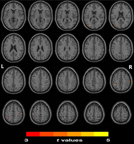 Figure 2 Changes in ReHo in the PD-MCI group compared with the PD-CN group (P<0.05, corrected with Bonferroni method). Regions of significantly increased ReHo included the left middle occipital gyrus (MOG), the left inferior parietal lobule (IPL), and the right postcentral gyrus (PCG).