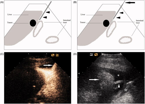 Figure 1. Artificial ascites technique in assisting MW ablation of hepatic tumours adjacent to the gastrointestinal tract. (A) A 16-gauge IV catheter (arrowheads) is inserted into the space between the surface of the liver and the gastrointestinal tract along the edge of the liver under ultrasound guidance. (B) The outer catheter (arrowheads) is advanced further to close to the index tumour whenever possible; then the inner stylet (arrow) is removed. (C) CEUS is helpful to best display the position of catheter (arrow). (D) Artificial ascites (*) successfully separates the gastrointestinal tract (☆) from the ablated area (arrow). The drip infusion is continued via the catheter (arrowhead) during the MW ablation procedure.