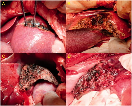 Figure 5. (A–C) Steps in the hepatic transection with a water-cooled double-needle MW ablation device. (D) Transverse section of routine hepatectomy with intermittent hepatic portal occlusion.