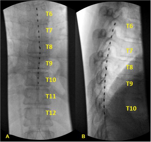 Figure 1 Lead placement, (A) anterior and (B) lateral views.Notes: Intra-operative fluoroscopy images demonstrate overlapping placement of the spinal cord stimulator leads from (A) anterior and (B) lateral views. The placement of the leads allows coverage from T6 down to T10 for optimal coverage of both back and leg as well as abdominal pain.