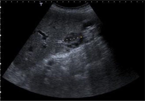 Figure 9 Abdomen ultrasonography showing a ganglion with 32 mm at hepatic hilum.