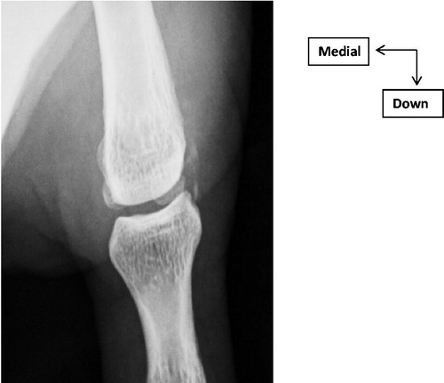 Figure 1. Inches x-ray: calcification of LCL of MCPP.
