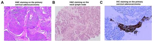 Figure 3 Hematoxylin & eosin (H&E)/immunohistochemistry (IHC) staining on the primary cervical adenocarcinoma/neck lymph node. (A) H&E staining on the primary cervical adenocarcinoma; (B) H&E staining on the neck lymph node; (C) IHC staining for HER2 on the primary cervical adenocarcinoma.