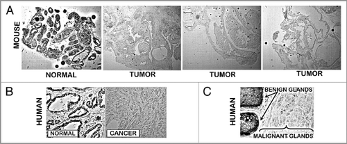 Figure 4 Dithizone zinc stain of prostate tissue sections. (A) Normal mouse prostate showing Zn-DTZ dark pigment formation due to presence of zinc. TRAMP tumors exhibit loss of zinc staining. (B) Our DTZ stain showing high Zn in normal peripheral zone glandular epithelium vs loss of Zn in peripheral zone adenocarcinoma. (C) DTZ staining of human prostate section which shows high Zn-DTZ in benign glandular epithelium and loss of zinc in malignancy (Gyorkey et al.Citation9).