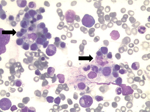 Figure 1. Haemophagocytosis observed in a bone marrow aspirate. Shown are two histiocytes (arrows) containing numerous haematopoietic elements within their cytoplasm (Wright-Giemsa stain).