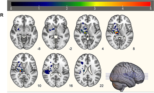 Figure 2 Lesion overlay map of stroke lesion location of patients (n = 23). The majority of the stroke patients had right-hemispheric stroke lesions (n = 14/23 patients). Patients with left-hemispheric lesions were flipped along the midsagittal plane. Consequently, the lesion were all on the right hemisphere. Color represents increasing number of patients with inclusion of that voxel into the lesion from blue to red.