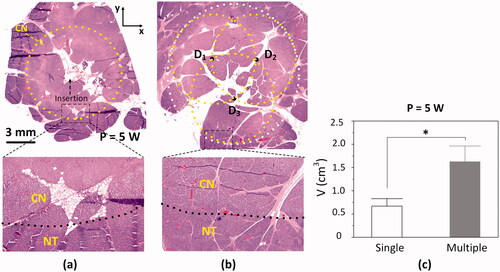 Figure 5. Histological assessments of irreversible thermal ablation on in vivo pancreatic tissue after laparotomy: HE-stained histology images of transverse section (xy plane) from pancreatic tissue treated with (a) single CILA and (b) multiple CILAs at 5 W for 200 s (top: 40× and bottom: 400×; CN = coagulation necrosis; NT = native tissue) and (c) comparison of ablation volumes after single and multiple CILAs at 5 W (*p < 0.05; N = 3 per group).