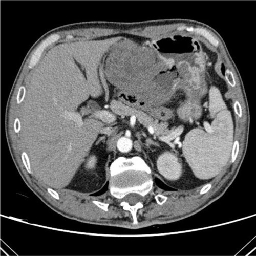 Figure 2 The enhanced-contrast CT image of a GIST with hemorrhage: the typical “air sign” is caused by hemorrhage and necrosis of the tumor.Abbreviation: GIST, gastrointestinal stromal tumor.
