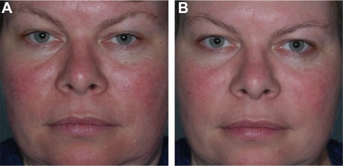 Figure 5 Before (A) and after (B) injectable botulinum toxin (Botox®, 10 U, 0.05 mL aliquots every 1–2 cm) intradermally into each cheek in combination with pulsed dye laser (10 mm, 10 msec, 7 J/cm).