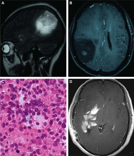 Figure 1 Pre- and postoperative MRI and histopathological diagnosis for patient 1.