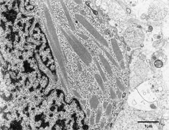 Figure 4 Oliogodendroglial cells contain many intracytoplasmic crystalline inclusions as well as a few mitochondria and abundant free polyribosomes, × 8,000.