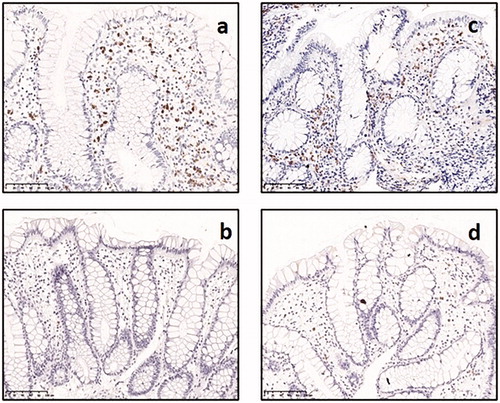 Figure 2. Immunohistochemical identification of eosinophils with EPO in rectal biopsies from: (a) twin with active Crohn’s disease, (b) healthy sibling among pair discordant for Crohn’s disease, (c) twin with active ulcerative colitis, (d) healthy sibling among pair discordant for ulcerative colitis