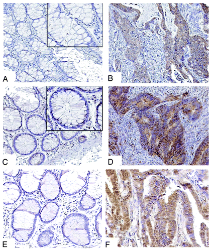 Figure 1. Immunohistochemical staining of Beclin 1, p62/SQSTM 1 and LC3 in human colon carcinomas. (A and B) Representative tissue sections show absent Beclin 1 expression in normal colonic crypt epithelial cells (A) compared with carcinoma (B) where Beclin 1 is localized to the tumor cell cytoplasm (×20). (C and D) Expression of p62 can be detected in normal epithelial cells (C) and is diffusely expressed in tumor cells (D) (×20). E, F. LC3 staining is absent in normal epithelia (E), but diffusely expressed in cancer (F) (×20).