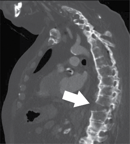 Figure 1. Computed tomography scan showing the T10–T11 extension fracture. Note the extension and distraction of T10–T11 (arrow) and the overall abnormal curvature of the spine.