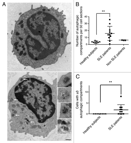 Figure 5. Increased number of autophagic vacuoles in peripheral T cells from SLE patients compared with healthy subjects (A) An example of a cell with a high number of autophagic vacuoles (black scale bar: 500 nm). Magnifications of identified autophagic structures are shown on the right side. The white scale bar (100 nm) stands for all the magnified images (B) Double-blind quantification of autophagic vacuoles in peripheral T cells isolated from the PBMC fraction obtained from healthy donors, patients with SLE or with other autoimmune diseases (Sjögren’s syndrome and vasculitis). Autophagic vacuoles were counted in 50 T lymphocyte sections. (C) Cell sections containing three or more autophagic vacuoles were counted for each subject. Each point represents the result for one subject. Central bars refer to the means and vertical bars stand for standard deviation. **p < 0.01 using unpaired t-test (in B) or Mann-Whitney U test.