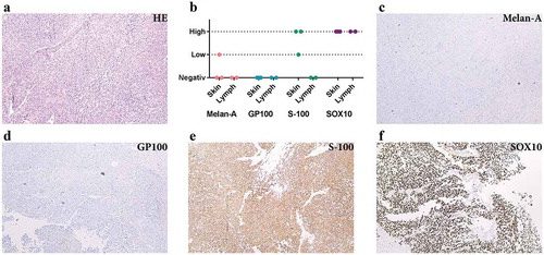 Figure 1. Immunohistochemistry analysis shows S-100 and SOX10 positivity in the metastatic melanoma tumour. (a) Haematoxylin and eosin staining of metastatic melanoma from lymph nodes composed of atypical pleomorphic elongated melanocytes with high-mitotic activity and focal necrosis. (b) Expression of melanocytic markers in metastatic melanoma from skin and lymph nodes (immunohistochemistry). (c–f) Immunohistochemical profile of a representative tumour: Melan A negative (c), GP100 negative (d), S-100 positive (e) and SOX10 positive (f). All images are at 100 × magnification. N = 5 for all stainings.