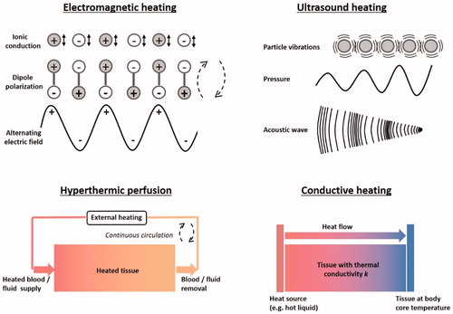 Figure 2. Schematic representation of the heating mechanisms of different clinical heating techniques: Electromagnetic (i.e., capacitive, radiofrequency, microwave, infrared and laser heating), focused ultrasound, hyperthermic perfusion and conductive heating.