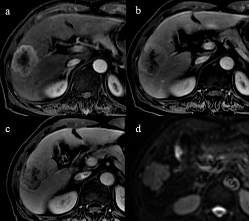 Figure 3 Hepatocellular carcinoma in a 74-year-old man with chronic hepatitis B. (a-c) On the axial arterial phase, portal venous phase and delayed phase images after administration of extracellular contrast agent, the segment-5 lesion showed thick-rim arterial phase hyperenhancement (APHE) followed by non-peripheral washout. (d) The mass showed a non-targetoid appearance on b-800 diffusion weighted image. The tumor was initially categorized as LR-M by observers. The tumor was re-categorized as modified LR-5 according to modified LI-RADS.