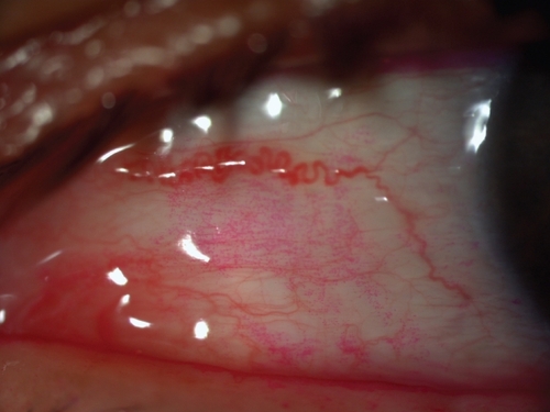 Figure 3 Typical dotted staining of the conjunctiva by rose bengal.