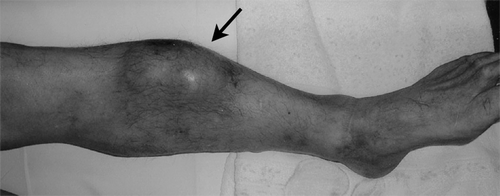 Figure 1.  Mid-portion of the calf viewed from the anterior aspect. A bulging, non-tender and elastic hard mass was covered with the thin and atrophic skin.