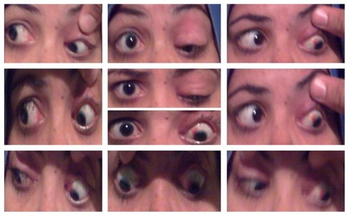 Figure 2 Preoperative presentation of Case 5 with left hypotropia and mismanaged ptosis by three sequential lid surgeries and lagophthalmos.