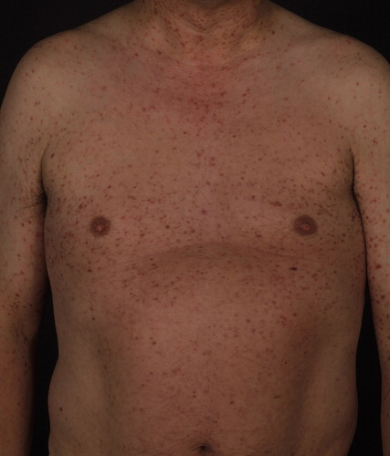 Figure 1. Urticaria pigmentosa in a patient with KITD816V-positive systemic mastocytosis.