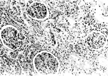 Figure 2 Kidney section of group 3 rat administered cisplatin (5 mg/kg) showing glomerular congestion. H & E. × 200.
