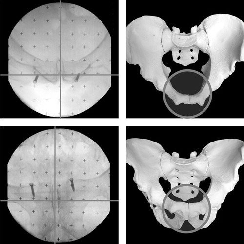 Figure 1. Inlet and outlet views of the pelvis were used to define the mid-pubic point. The inlet view is characterized by overlying superior and inferior pubic rami.