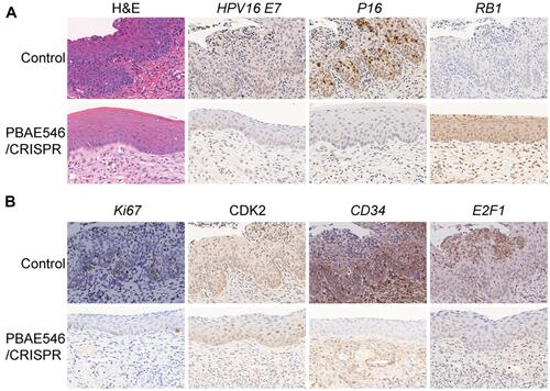 Figure 6 Therapeutic effect of NPs composed of PBAE546 and CRISPR/Cas9 recombinant plasmids targeting HPV16 E7 in the vaginas of HPV16 transgenic mice. (A and B) Representative images of H&E and IHC staining of the cervical epithelium between the HPV16 transgenic mouse control group and the HPV16 E7 NPs (PBAE546/plasmid 60:1, 10 μg of plasmid per day for 20 days) treatment group. IHC staining indicators included HPV16 E7, P16, RB1, Ki67, CDK2, CD34 and E2F1. Scale bars, 20 μm.