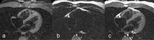 Figure 2. (a) Water and (b) fat images of a normal subject generated from a single DBIR RADFSE k‐space data set. (c) Lipid map (bright white pixels) generated from (b) and overlaid on (a).