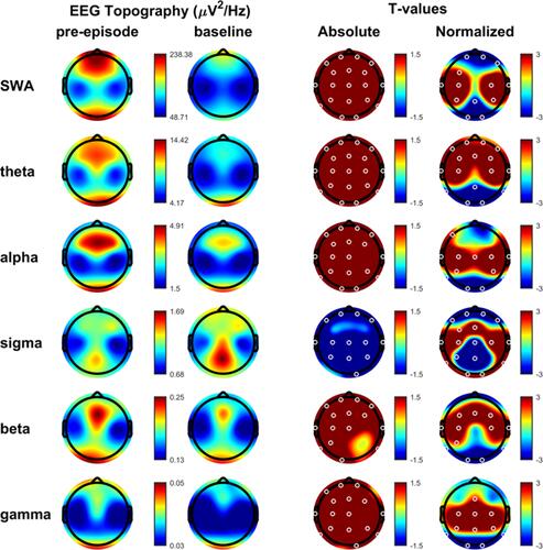Figure 1 Pre-episode versus baseline. Spectral bands of all DoA episodes analyzed, for each band frequency: slow wave activity or delta (0.5–4 Hz), theta (4–8 Hz), alpha (8–12 Hz), sigma (12–16 Hz), beta (15–25 Hz), and low gamma (25–45 Hz). First column: average NREM sleep EEG topographies across frequency bands during pre-episode. Second column: topographic averages during stable NREM sleep, two to three minutes before the episode. Third column: map showing the individual electrode t-value (two-tailed, paired) maps for the comparison between pre-episode and baseline sleep in terms of absolute power. Red values represent an increase in absolute EEG power and blue values represent a decrease. Fourth column: same as third column except that each subject was spatially normalized using the z-score across electrodes before creating the t-value comparison. White dots belong to significant clusters (P < 0.05) using statistical non-parametric mapping for multi-comparison correction.