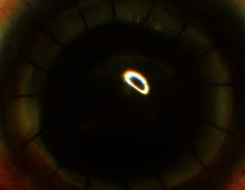 Figure 3 Whitish deposition over the graft on the 20th postoperative day with healing epithelial defect under the bandage contact lens.