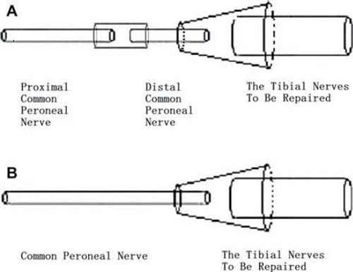 Figure 1. Schematic diagram of experimental animal models. (A): The common peroneal nerve was transected 5 mm below the sciatic nerve bifurcation point and the distal and proximal nerve stumps were bridged at the breakpoint using the conduit. Three months after the first surgery, the common peroneal and tibial nerves were transected 1 cm below the first breakpoint and the proximal common peroneal nerve was used as the donor to repair the distal tibial nerve after it was also transected. Schematic diagram of control group animal models (B): The control group animals were anesthetized and the sciatic nerve was exposed without surgery and the wound was closed. Three months after the first surgery, the common peroneal and tibial nerves were transected and the proximal common peroneal nerve and the distal tibial nerve were bridged using the conduit.