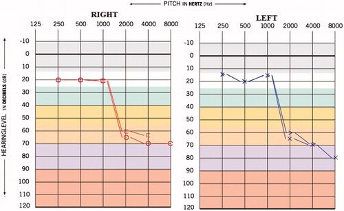 Figure 6. Post-medication audiogram of case 3.