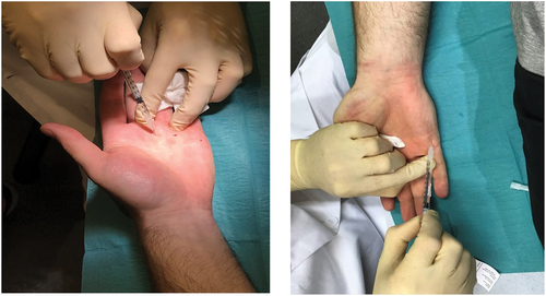 Figure 3. Injection of BTX-A were given near the neurovascular bundle at the A1-A5 pulley at the basis of digit 1–5 in the palm of the hand.