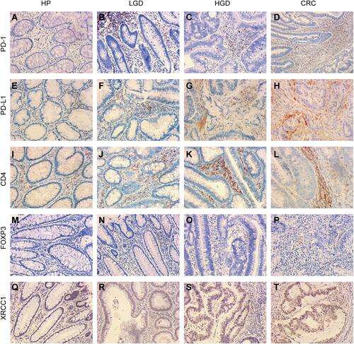 Figure 1 Immunohistochemical expression of XRCC1, CD4, FOXP3, PD-1, and PD-L1 in clinical samples of HPs, LGDs, HGDs, and CRCs (all images: original magnification, ×200). (A–D) PD-1 epithelial expression in infiltrating lymphocytes. (E–H) PD-L1 epithelial expression in infiltrating lymphocytes. (I–L) CD4-positive intraepithelial lymphocyte density. (M–P) FOXP3-positive intraepithelial lymphocyte density. (Q–T) XRCC1 nuclei expression in colonic epithelial cells and tumor cells.