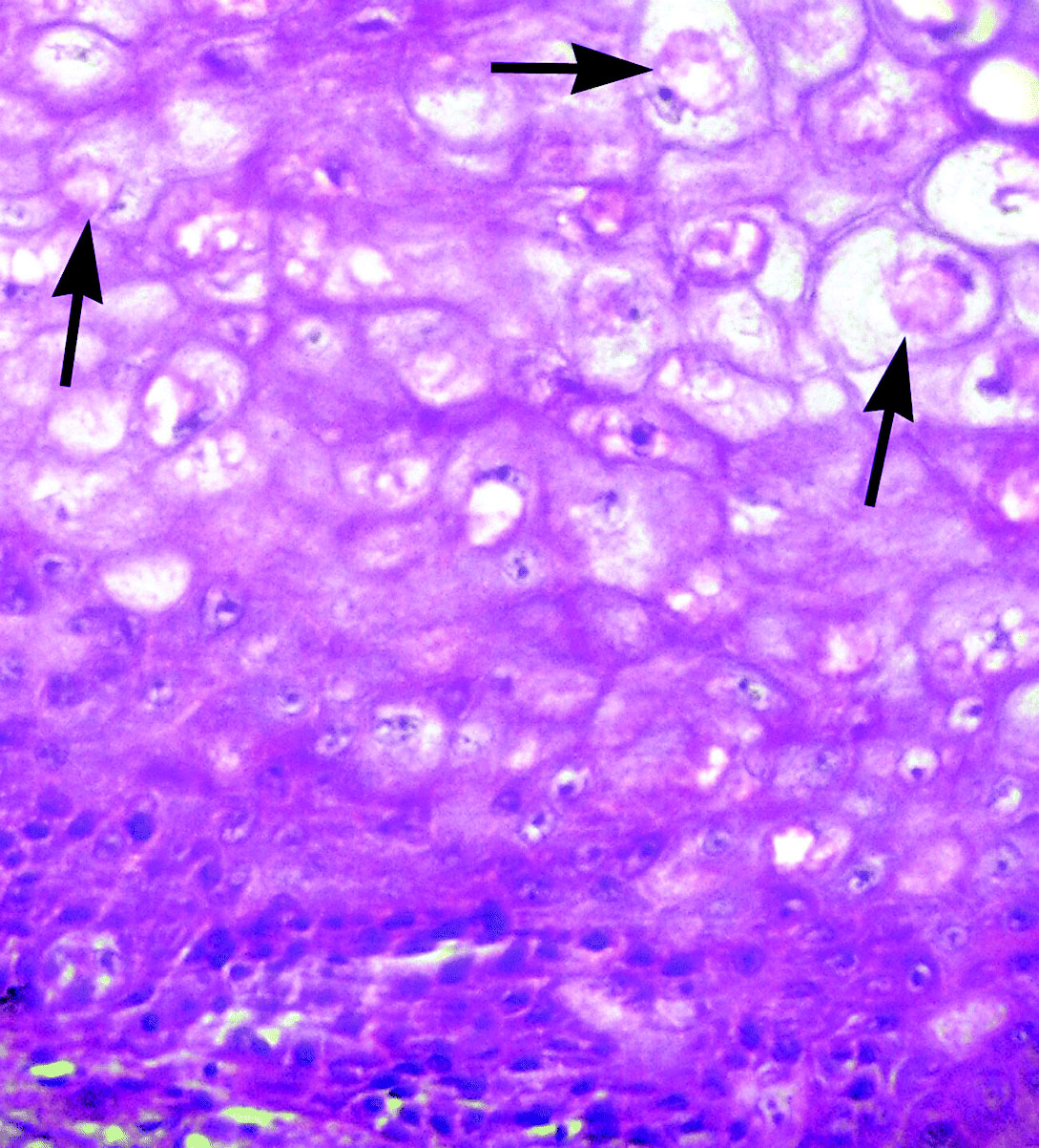 Figure 6.  Histopathology of avian pox lesions in peafowl chicks showing swollen keratinocytes having eosinophilic intracytoplasmic (Bollinger bodies) inclusion bodies (arrows) pushing the nucleus to a side. Haematoxylin and eosin. Magnification x400.