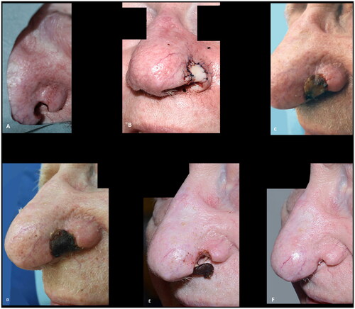 Figure 9. (A,B) Intraoperative view of the full thickness defect and the composite graft. (C–E) Composite graft at seven, thirteen and sixteen days postoperatively. (F) The result six weeks postoperative after secondary healing. The patient declined further reconstruction. The outcome was rated as poor.
