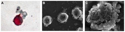 Figure 2 Images of A549 cell enrichment by immunomagnetic nanoparticles. (A) The positive enriched cell was stained with ICC; (B) SEM image of many immunomagnetic nanoparticles attached to A549 cells; (C) SEM image of immunomagnetic nanoparticles binding to the surface of an A549 cell.Abbreviations: SEM, scanning electron microscopy; ICC, immunocytochemistry.