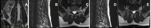 Figure 16 Individual with moderate L5S1(*) stenotic NF displayed with 3°axial cut from anatomical parallel (yellow line ^) (A–C). This small slice deviation from anatomical normal in mild stenosis creates a minimal NF change at the level of the spinal nerve(*) on axial evaluation, but an approximately 50% NF side-to-side caliber difference when the slice is taken below the spinal nerve (**) (D and E).