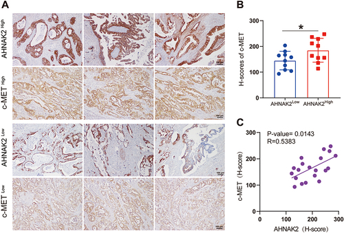 Figure 6 AHNAK2 correlates with c-MET expression in PDAC at protein level. (A) Representative immunohistochemical staining images of c-MET expression corresponding to high and low expression of AHNAK2 (AHNAK2High and AHNAK2Low) in PDAC specimens (n=10). (Scale bar, 100 µm). (B) Tumour samples were categorised according to AHNAK2 expression levels into high and low, according to the H-score, and rescored for c-MET. (C) Correlation analysis using the H-scores of AHNAK2 and c-MET (Spearman correlation test). Each bar represents Mean ± SD. *p<0.05.