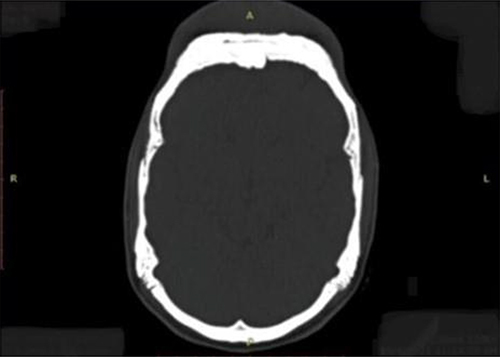 Figure 2 CT scan (the bone window) shows hyperostosis of the frontal bone with a well-defined outline measuring 2.2 cm at its maximum thickness.