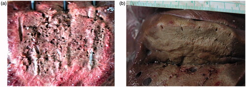Figure 3. (a, b) After the completion of ablation, transection of the liver parenchyma was performed using a scalpel.