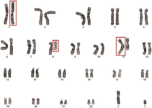 Figure 3. Karyotype of the male patient showing the three-way exchange involving chromosomes 1, 8 and 11 in Case II: 46, XY,t(1;8;11)(1qter→1p22::8q11.1→8qter)(8pter→8q11.1::11q22→11qter)(11pter→11q22::1p22→1pter).