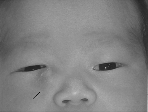 Figure 1 Image showing a large dacryocystocele causing an upward tilt of the inner canthus of the right palpebral fissure (arrow) in patient 1, a 5-day-old male infant.