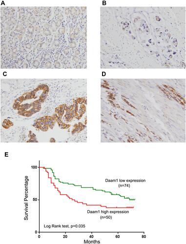 Figure 1 Expression of Daam1 in gastric cancers. (A) Weak Daam1 staining in normal gastric mucosa. (B) Weak Daam1 staining in a gastric mucinous adenocarcinoma. (C) Strong cytoplasmic and membraneous Daam1 staining in a case of gastric tubular adenocarcinoma. (D) Strong cytoplasmic Daam1 staining in a case of signet-ring cell carcinoma. (E) Kaplan–Meier curves showed that high Daam1 expression in gastric cancer associated with poor cumulative survival (p=0.035, Log rank test).